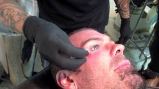 Rich Piana getting dermal implant removed