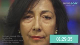 Remescar Tränensäcke und Augenringe AT - Live Demo Isabel