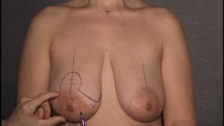 Breast Lift / Mastopexy Surgery