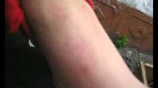 Последствия употребления наркотиков 2