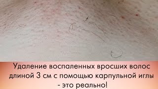 Вросшие волосы удаление, лечение\The ingrown hair