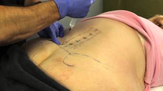 Tulsa Prolotherapy Low Back (Lumbar)