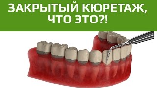 Лечение десен. Закрытый кюретаж – чистка пародонтальных карманов