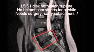 ChixHealth: L5/S1 disk herniation