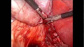 Colecistectomia paso a paso