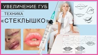 Техника Увеличение губ "СТЕКЛЫШКО" / работает ученица на моем курсе Контурная пластика