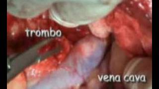 Neoplasia ghiandola surrenale destra cane
