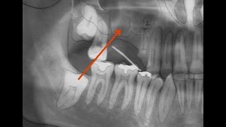 REABILITAÇÃO ORAL, VÍDEO 1 - REMOÇÃO 3º MOLAR INCLUSO, COLETA DE OSSO AUTÓGENO E MATRIZ DENTINÁRIA