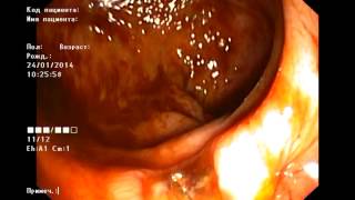 Endoscopic clipping for rectal bleeding. Эндоскопическая остановка кишечного кровотечения