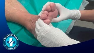 Síntomas del problema del pie diabético