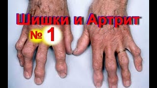 Шишки на пальцах рук- как избавиться от шишек на пальце - № 1 | Артрит суставов на руках | #edblack