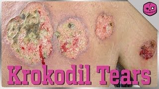 KROKODIL: The Flesh-Eating Russian Street Drug
