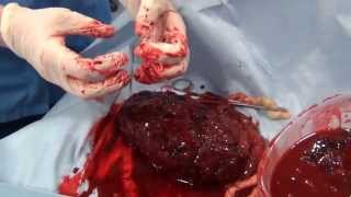 Placenta and Umbilical cord explanation from midwife (Just after Birth)