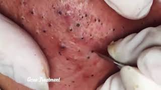 Vídeos de Esteticista Tirando Cravos e Espinhas