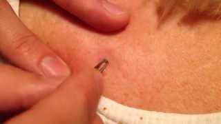 Grandmas black zit