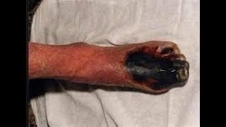 Diabetic Gangrene\диабетическая гангрена