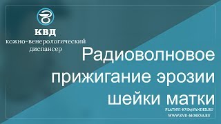 601  Радиоволновое прижигание эрозии шейки матки