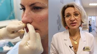Безоперационная ринопластика