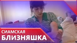 Сиамская близняшка Зита в тяжелом состоянии госпитализирована в Москве
