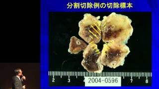 胃がんの内視鏡治療（検診）について　田邉 聡