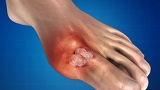 Gout: Treatment, Causes, Massage Therapy, Prevention