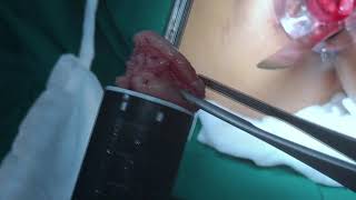 Dr Ashwin Porwal technique for Transanal rectal Resection of Rectal Prolapse by Stapler