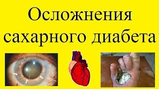 осложнения сахарного диабета