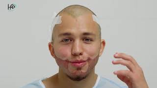 Интервью после пересадки бороды. Сергей Романович | HFE Clinic (6+)