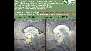 Priča male hrabre Mie - lečenje dece kanabisom u Srbiji