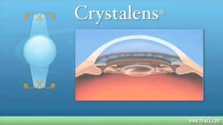 Premium IOL Implants - Tylock Eye Care & Laser Center in the Dallas, Fort Worth area