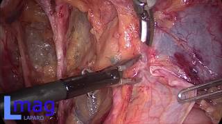 Операция Вертгейма. Этап 2: Радикальная гистерэктомия \ Operation Wertheim. Step 2: Hysterectomy