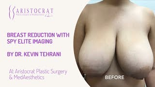 Breast Reduction with SPY Elite Imaging Long Island, New York by Dr. Kevin Tehrani