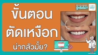 เลเซอร์ ตัด เหงือก มีขั้นตอนอย่างไร โดย คุณหมอฝากมา