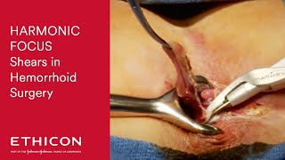 Hemorrhoidectomy with HARMONIC FOCUS® Curved Shears
