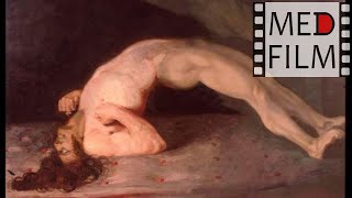 Эпилепсия, падучая, эпилептический припадок © EPILEPSY