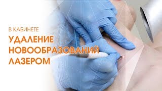 Папилломы. Удаление папиллом. Лазерное удаление новообразований [Линлайн Сеть клиник]