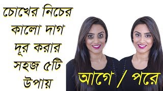 চোখের নিচের কালো দাগ দূর করার উপায়,BD Health tips, The way to remove black spots in the eye below