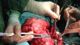 Prof. Aziz Aliyev. Thyroid Surgery With Lymph Node Dissection