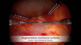 augmentation mammaire par voie axillaire endoscopique (aisselle)