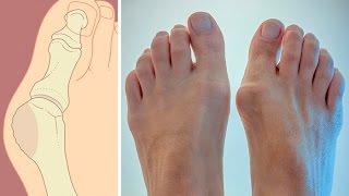 Как избавиться от косточки на ноге? Советы Елены Малышевой