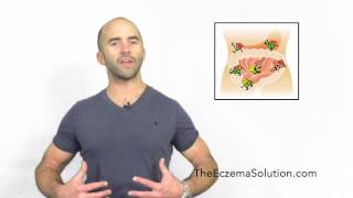 The Eczema Solution - What Causes Eczema?
