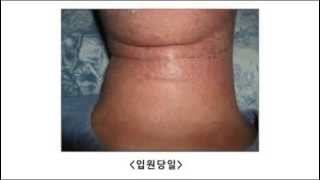 아토피피부염의 입원치료 by 윤영희 교수(강동경희대한방병원)