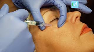 Как убрать гусиные лапки под глазами и морщины на лбу без Botox