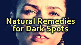 Natural Remedies for Dark Spots, Uneven Skin Tone and Hyperpigmentation