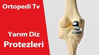 Yarım Diz Protezi - Ortopedik Bilgi
