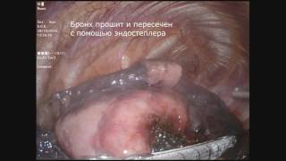 Торакоскопическая нижняя лобэктомия при раке легкого (РНЦХ им.акад.Б.В.Петровского)