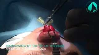 Открытая ринопластика.OPEN RHINOPLASTY