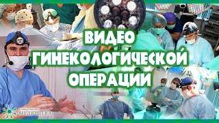 Гистероскопическое удаление полипа эндометрия  в постменопаузе