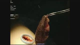 ВАТС однопортовая верхняя лобэктомия справа (РНЦХ)