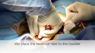 Penile Implant with Simultaneous Circumcision Single Incision SUHD 4k